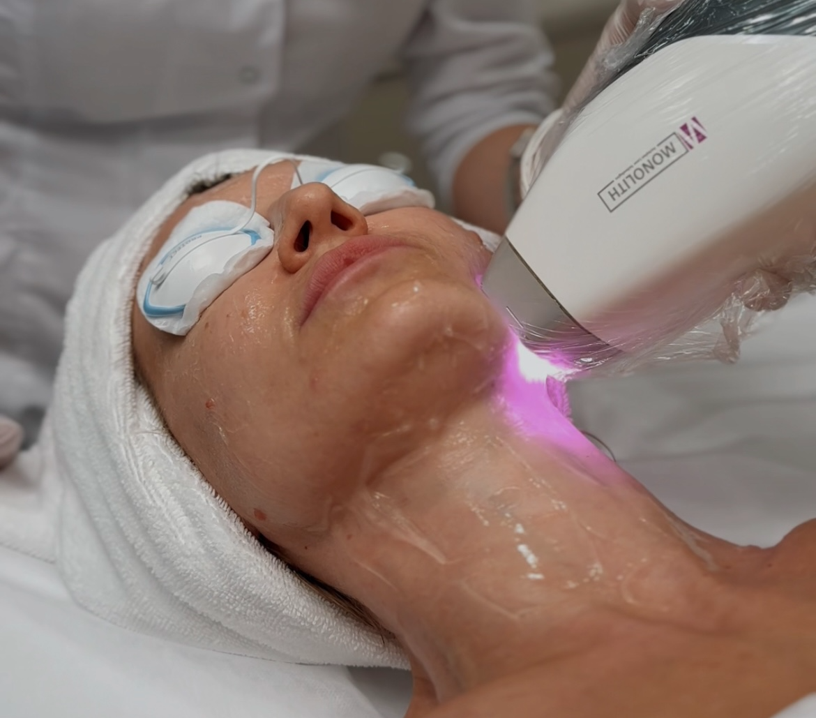 Лазерное лечение акне на аппарате ASCLEPION