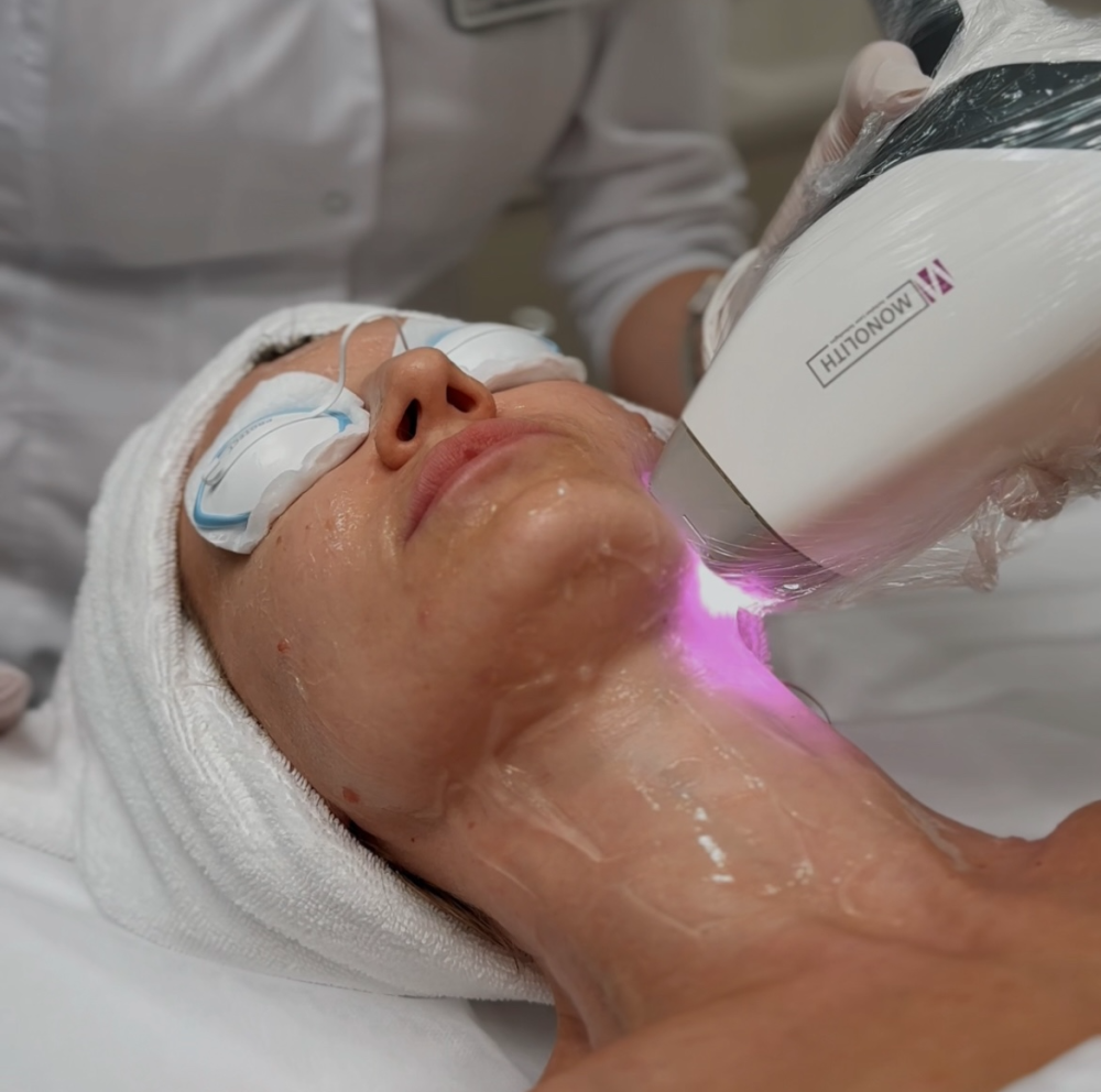 Лазерное лечение акне на аппарате ASCLEPION